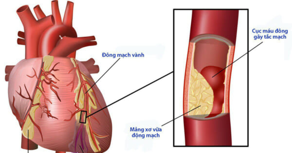 tăng huyết áp gây biến chứng tim mạch