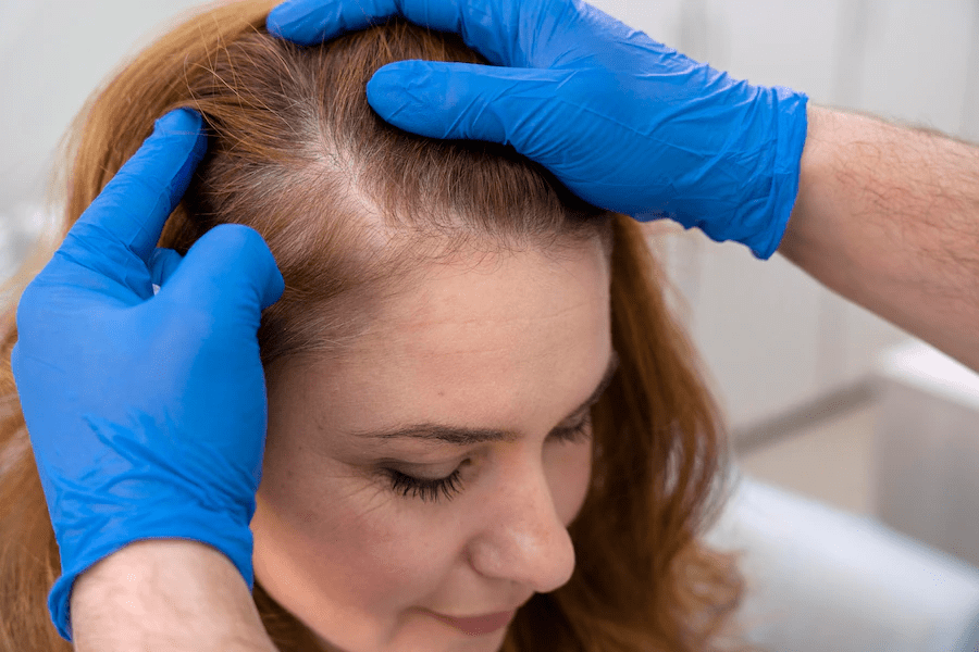 Cách khắc phục rụng tóc ở nữ giới