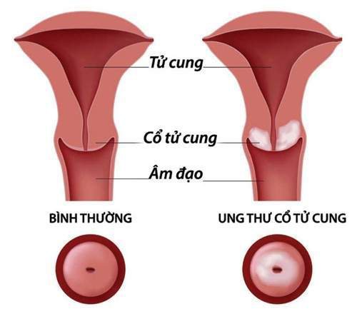 ung thư cổ tử cung