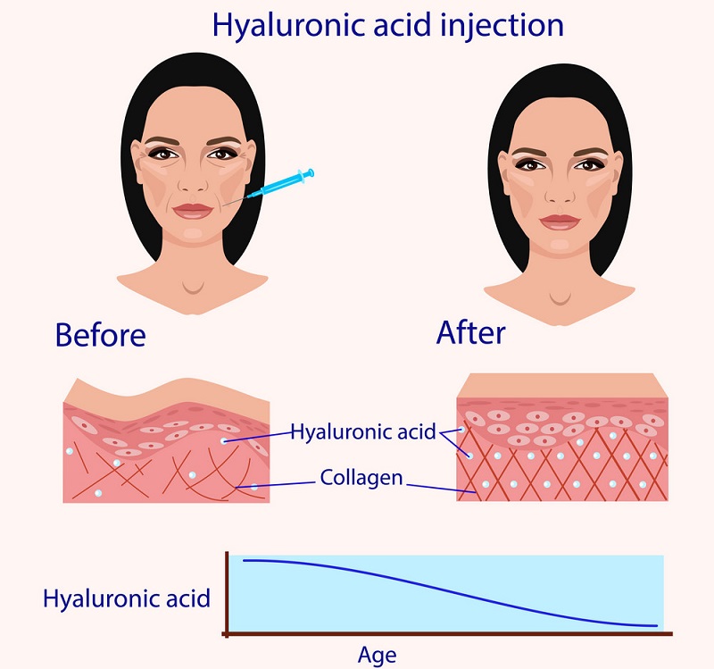 Hyaluronic Acid là gì?